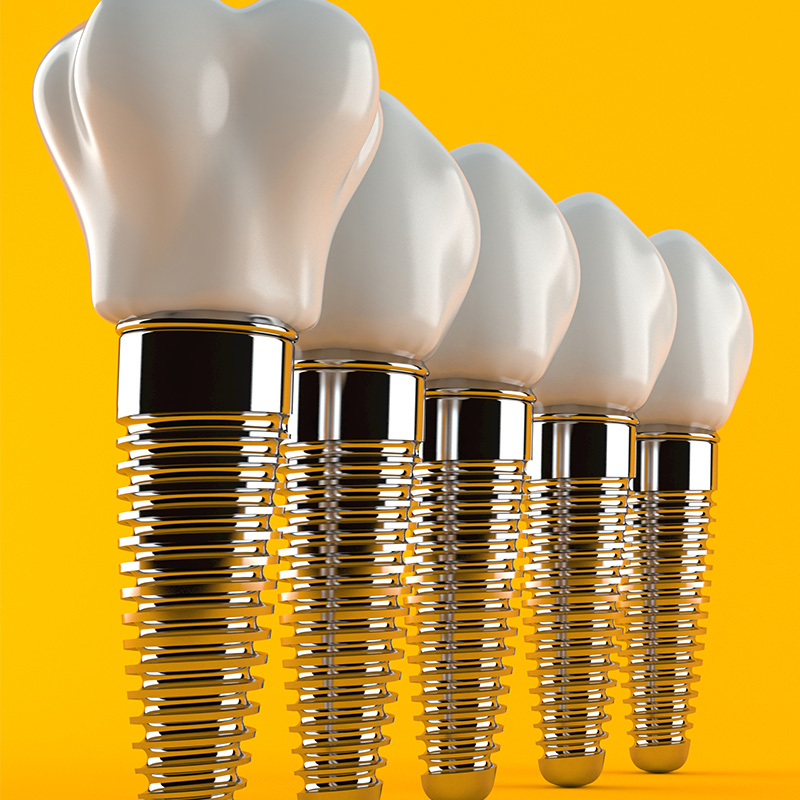 Featured image for “Adapting to the Rising Demand in Implant Dentistry”